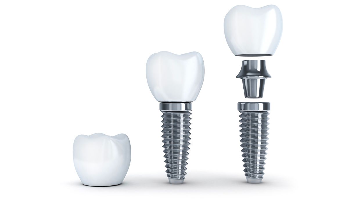 dental implant 