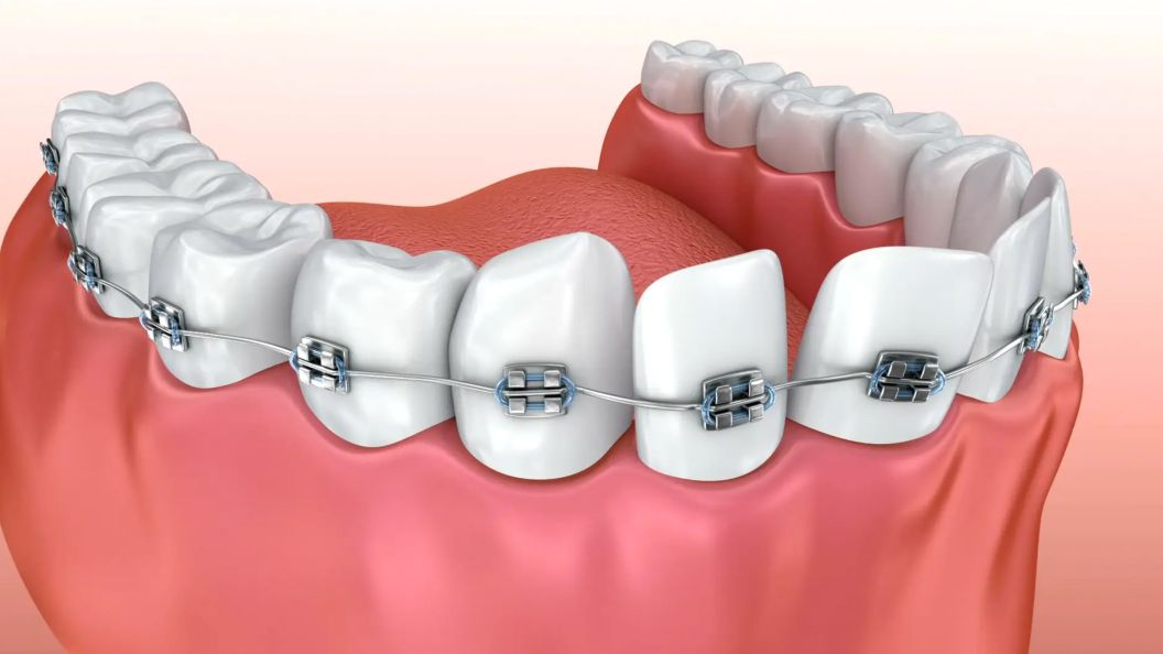 Orthodontic Braces With Missing Teeth - Sturbridge Ortho